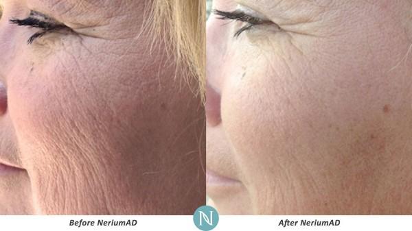 nerium reviews